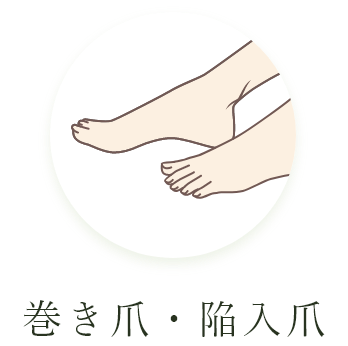 巻き爪・陥入爪