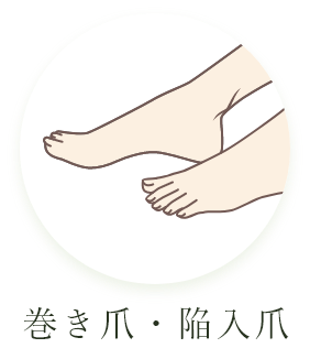 巻き爪・陥入爪