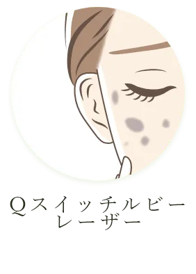 Qスイッチルビーレーザー
